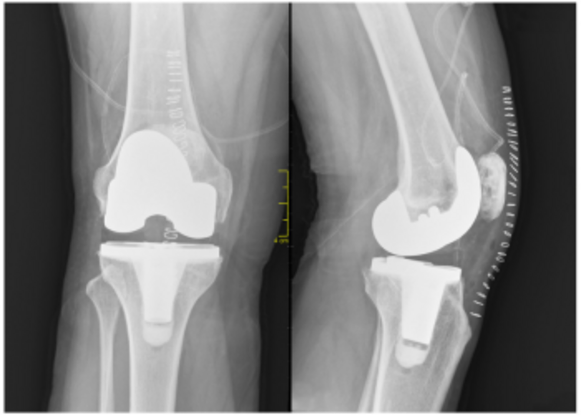 Joint Replacement Surgeries