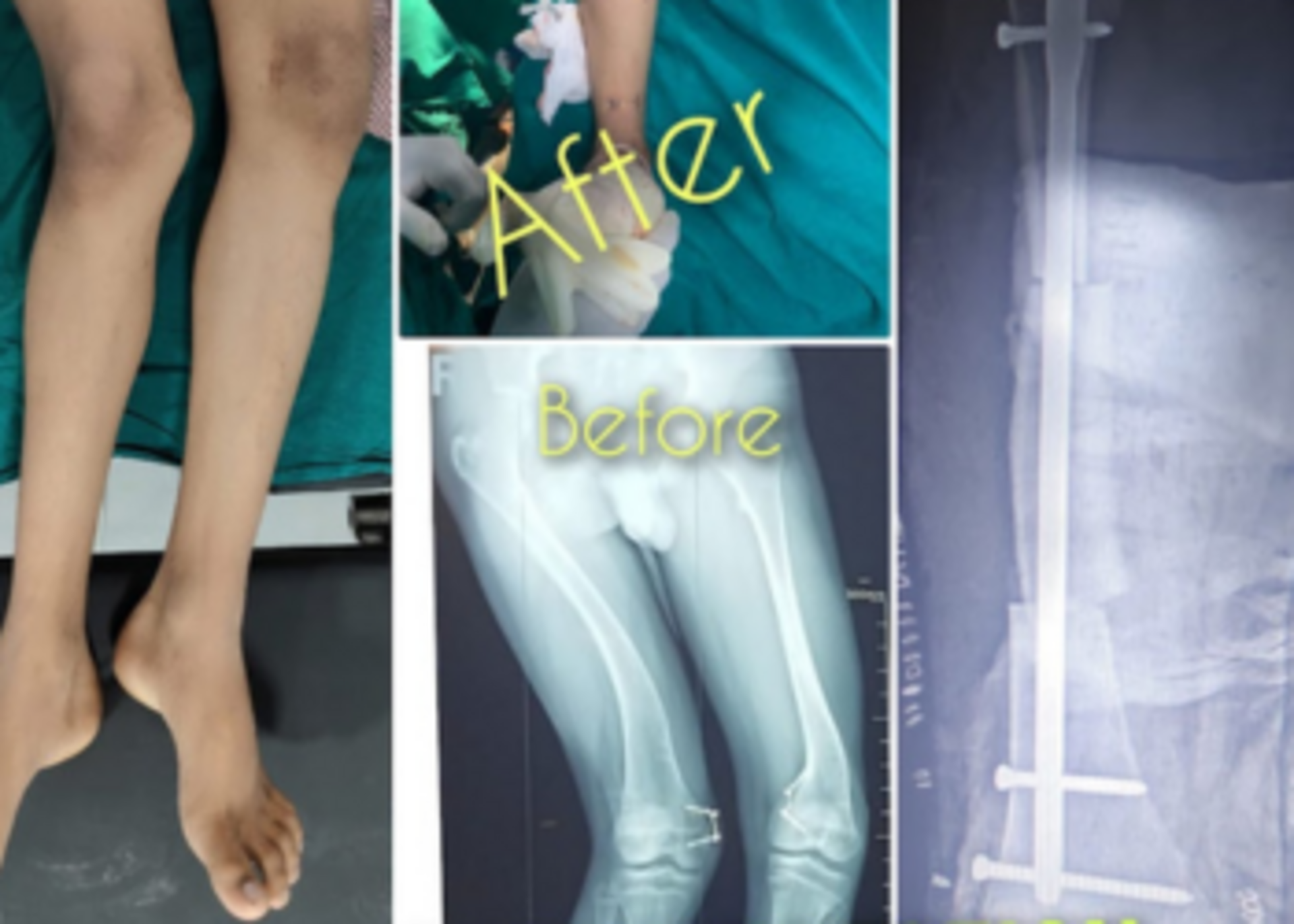 Deformity Correction (Knee and Foot)