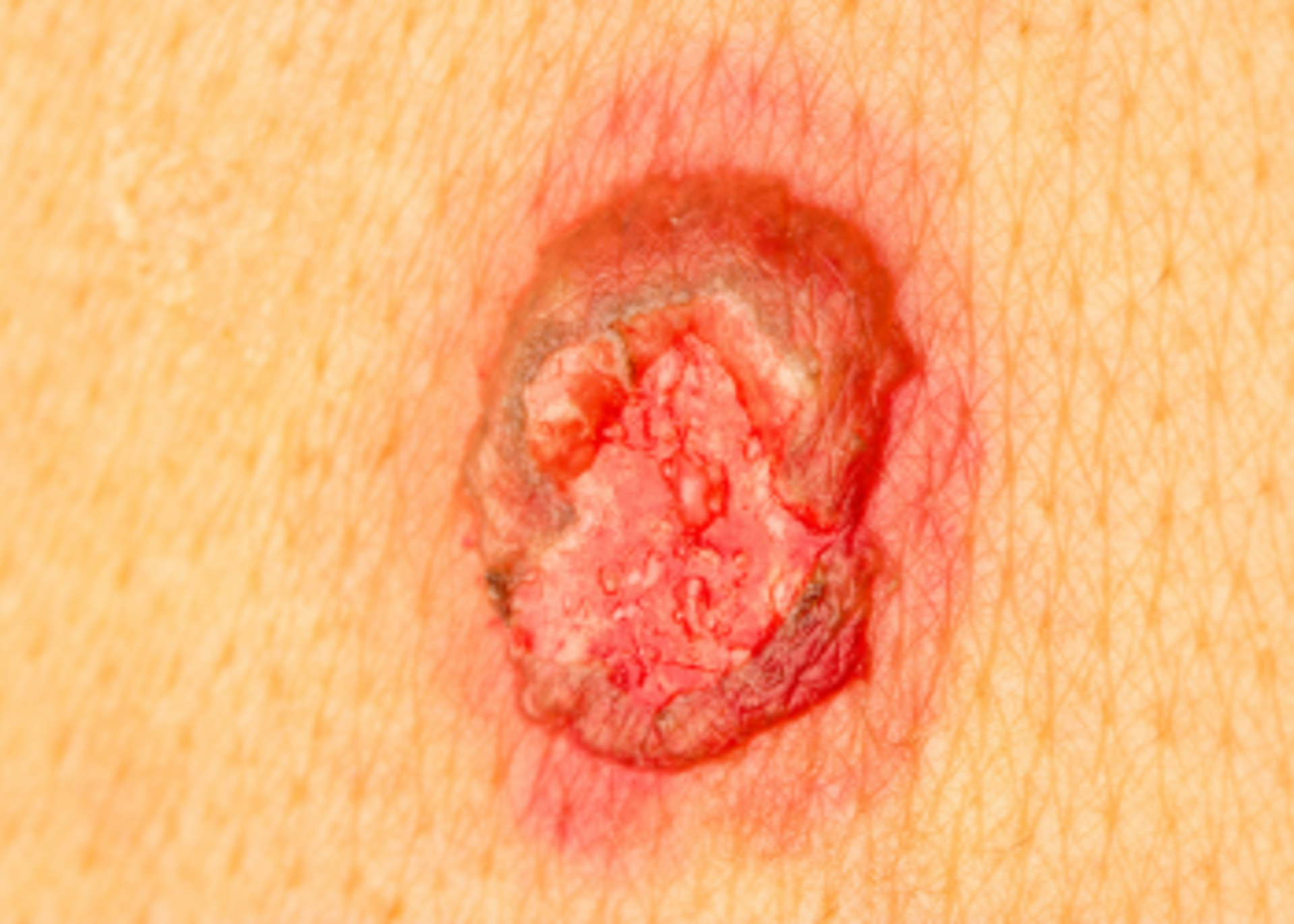 Non Healing Wound Management